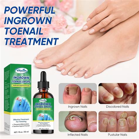 Ingrown Toenail Treatment Drops - Fast Acting Pain Relief & Softener 30ml | Buy Now with Express ...