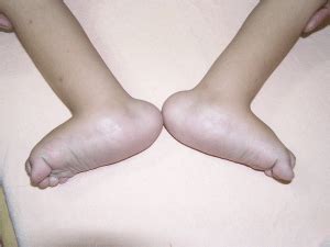 Rocker bottom Feet – OrthoPed
