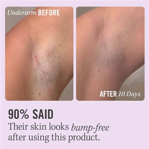 Ingrown Armpit Hair How To Get Rid Of at Mia Rooke blog