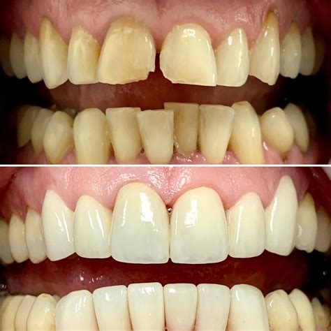 chipped teeth-before/after | Dr. Gentry