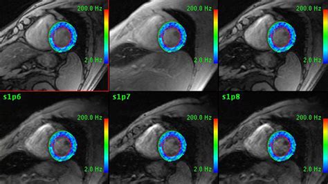 Cardiology Advanced Visualization | GE Healthcare (India)