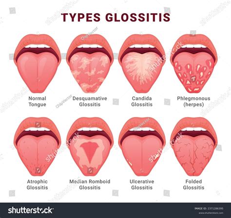 Normal Tongue Vs Thrush Thrush (Oral Candidiasis) Condition,