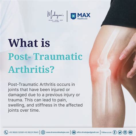 Dr. Ramneek Mahajan on LinkedIn: #arthritis #posttraumaticarthritis #injury #jointpain #trauma # ...