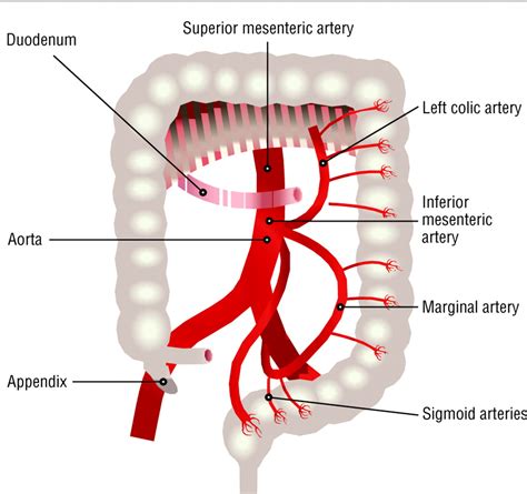 Diagnosis and management of intestinal ischaemic disorders | The BMJ