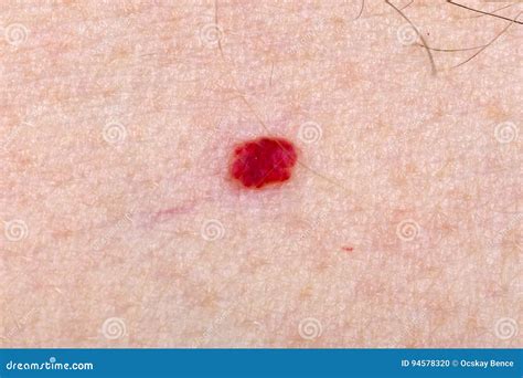 Angioma Of Skin