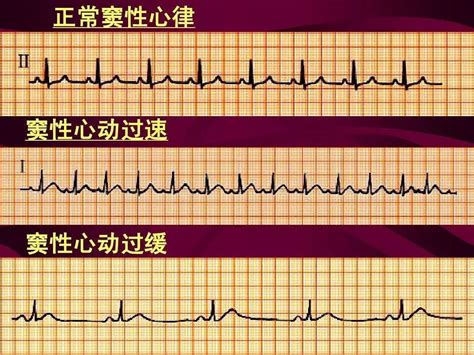 心电图图例分析：窦性心动过速、房性心动过速伴不规...