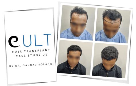 Hair Transplant Results Case Studies 1-30 | Cult Aesthetics