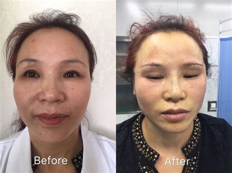 Image result for Thread Lift Problems