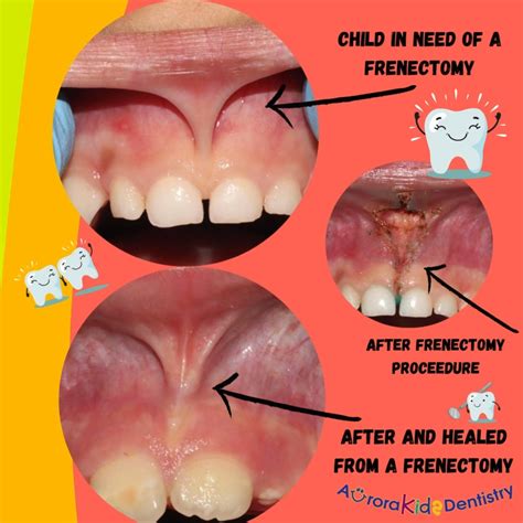 Upper Labial Frenulum Surgery My Adult Tongue Tie Release: Symptoms,
