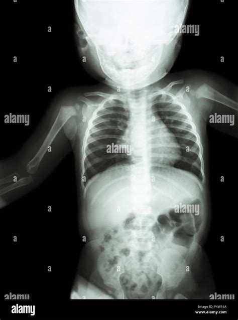 Film x-ray child 's body ( normal baby Stock Photo, Royalty Free Image ...