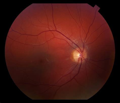 Moran CORE | Bull’s Eye Maculopathy as a Phenotypic Presentation of Stargardt Disease