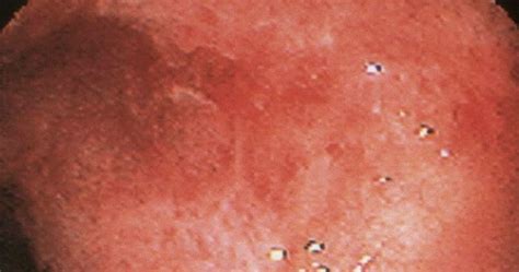 Image result for Colonoscopy Colitis