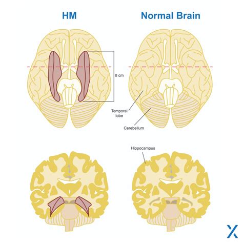 Retrograde Amnesia Brain