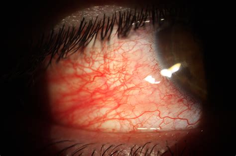 Why is my eye red? – Los Alamos Family Eyecare, P.C.