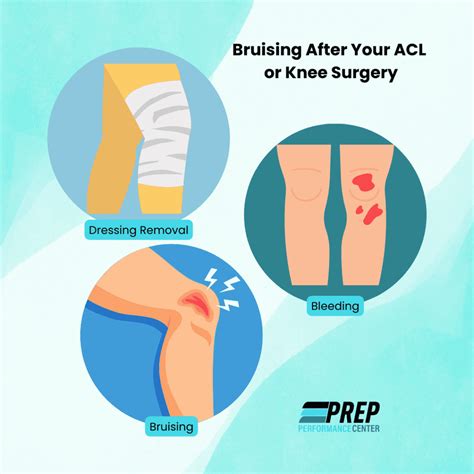 Bruising On Foot After Knee Surgery Deals | emergencydentistry.com