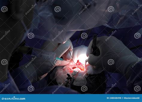 Treatment of a Brain Aneurysm. Surgical Operation on the Brain. a Team of Surgeons Performing ...