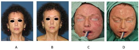 Total Facial Autologous Fat Grafting for Treating Skin Manifestations in Scleroderma