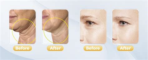 ENLIWISH Red Light Therapy for Face, 7 Color LED Skin Rejuvenation for ...