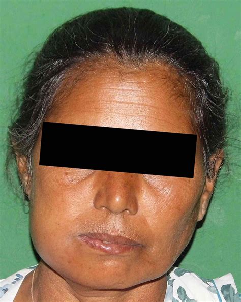 Head & Neck Space Infection