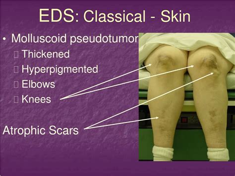 PPT - Ehlers Danlos Syndrome: Recognition, Diagnosis & Management PowerPoint Presentation - ID ...