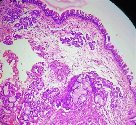 IJPO - Indian J Pathol Oncol