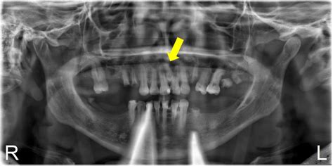 Non-Syndromic Familial Mesiodens: Presentation of Three Cases