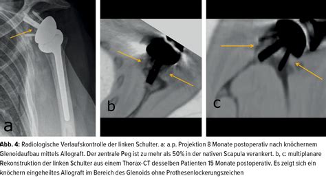 Allogene Knochentransplantate bei der Verwendung von inversen ...