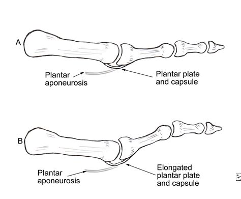 Hammer Toes Cause And Treatment Method | quarrelsomeanot00
