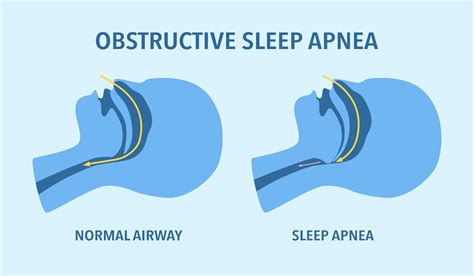 New Technology for Treating Sleep Apnea | St. Luke's Ear, Nose and ...