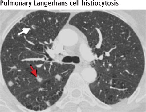 What Does Lung Scarring Look Like On Ct Scan Ct Scan Machine Imaging