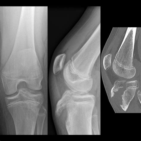 Pediatric Knee Joint Effusion | Pediatric Radiology Reference Article ...