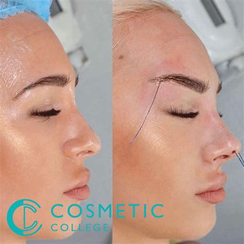 Image result for Fox Eye Thread Lift Procedure