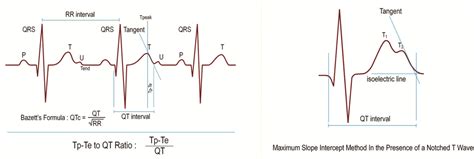Elevated LV Mass and LV Mass Index Sign on the Athlete’s ECG: Athletes ...