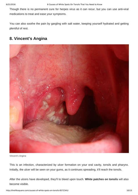 PPT - 8 Causes of White Spots On Tonsils You May Not Know PowerPoint Presentation - ID:7357905