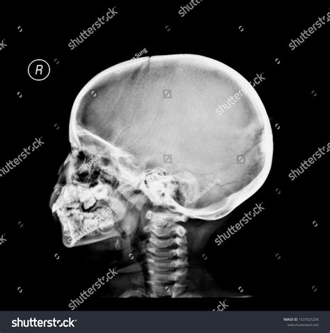 Film Xray Child Skull Cspine Stock Photo 1537025204 | Shutterstock