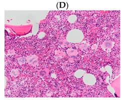 Molecular Genetics of Thrombotic Myeloproliferative Neoplasms ...