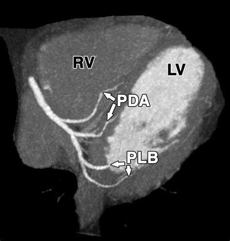 Normal and Variant Coronary Arterial and Venous Anatomy on High ...