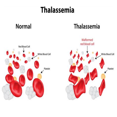 World Thalassemia Day