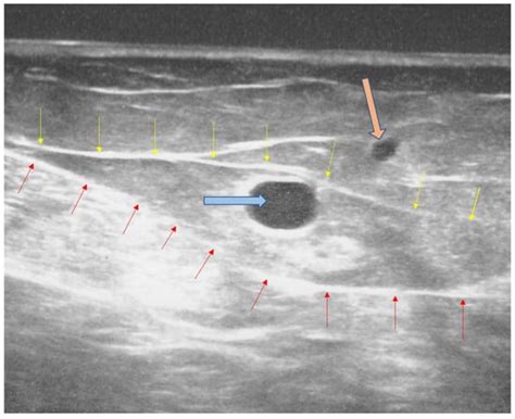 Clinical Anatomy of the Lower Extremity Veins—Topography, Embryology ...