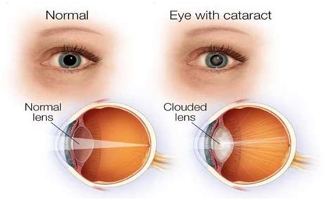 मोतियाबिंद के कारण, लक्षण, इलाज और बचाव - Cataracts (Motiyabind) in Hindi