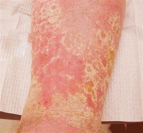 Stasis Dermatitis Causes