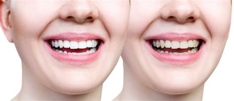 Broken Front Tooth Repair