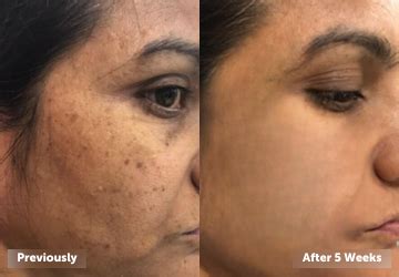 LAURITZ | Unique biotechnology for skin health and beauty