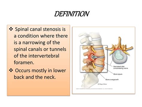 spinal canal stenosis.pptx definition, classification, pathophysiology, clinical features ...