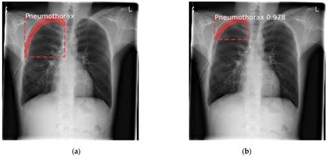 Deep Learning-Based Computer-Aided Pneumothorax Detection Using Chest X ...