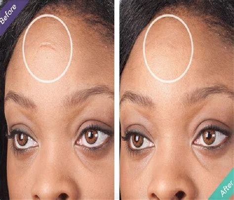 No Sugery, No Treatment, पुरानी चोट के निशान गायब करेंगे ये 7 देसी ...