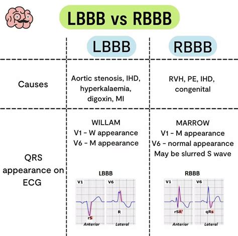 LBBB Vs RBBB - MEDizzy