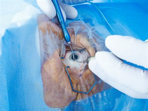 Eye Injection 的图像结果