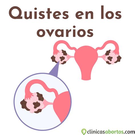 Quiste ovárico: Síntomas, tipos y tratamiento | Guía completa
