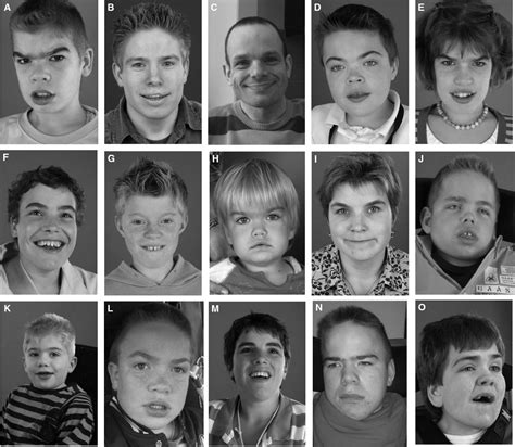 Mucopolysaccharidosis type III (Sanfilippo syndrome) and misdiagnosis of idiopathic ...